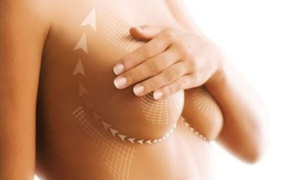 Suture lift for breast enlargement