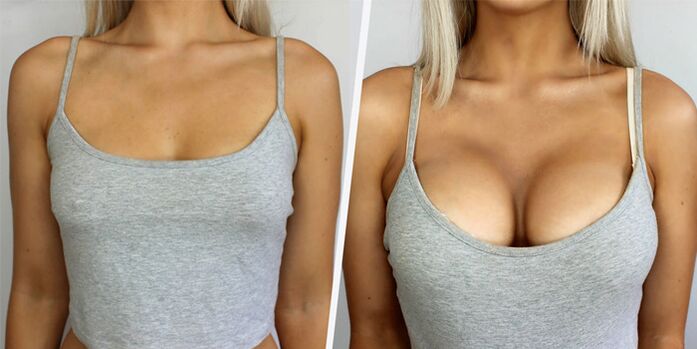 before and after plastic surgery for breast augmentation
