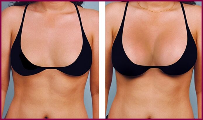 before and after breast augmentation with fat