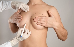 Methods of breast augmentation with surgery