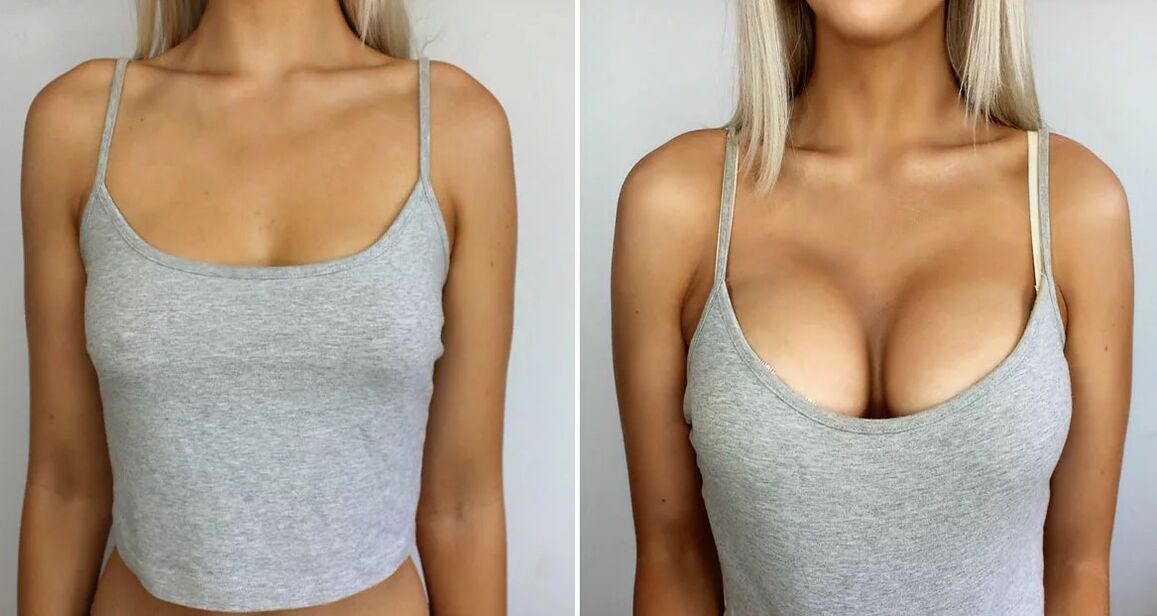 Breast augmentation 3 size