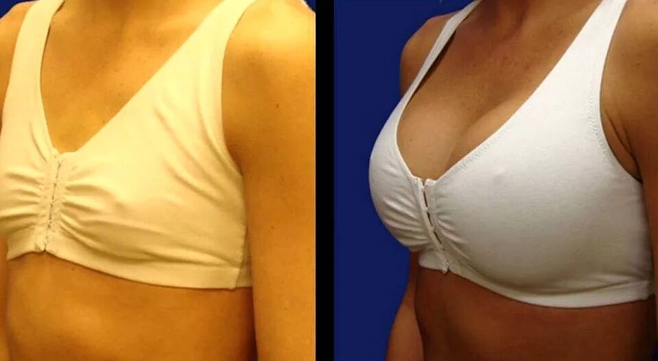 Breast photo before and after the operation