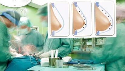 How a breast lipping is carried out