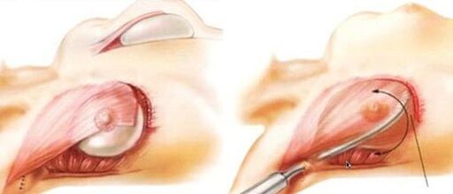 How a breast augmentation operation is carried out