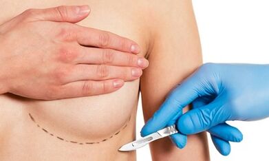 Submammatic access to breast enlargement with implants