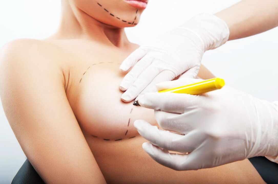 Markings before breast enlargement surgery