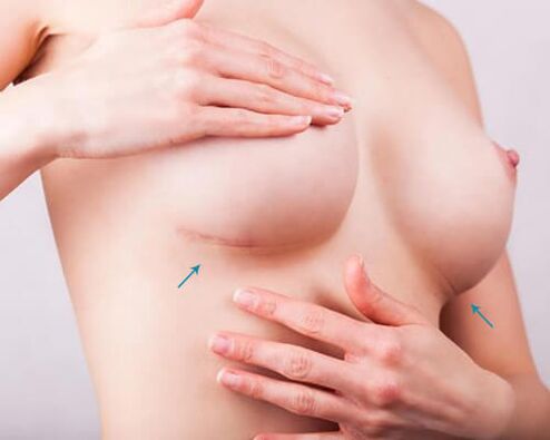 Breast augmentation with implants