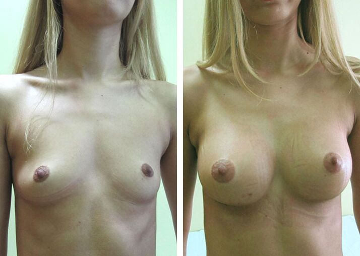 Breast before and after breast enlargement