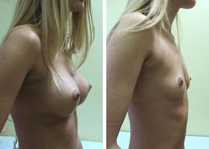 The result of breast enlargement with implants