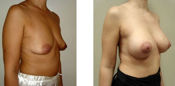 Breast before and after breast enlargement