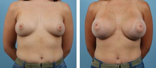 Photos before and after breast enlargement