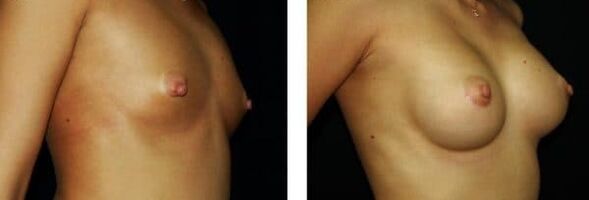 before and after breast enlargement