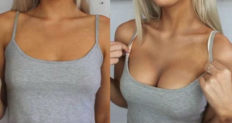 Before and after breast enlargement