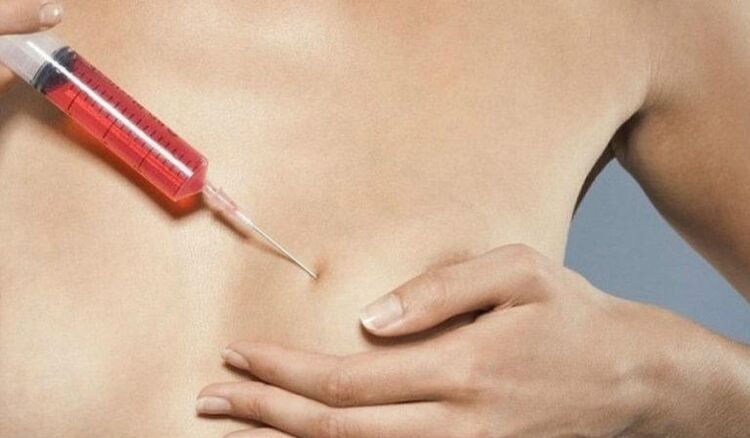 Breast enlargement with hyaluronic acid injections