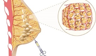 Contraindications for breast augmentation with your own fat