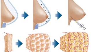 How is breast augmentation performed with fat