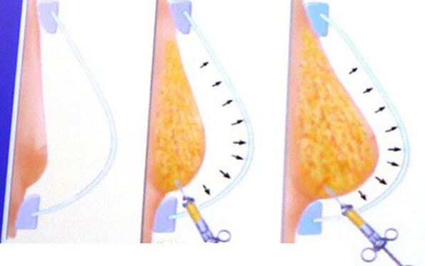 Breast enlargement with fat