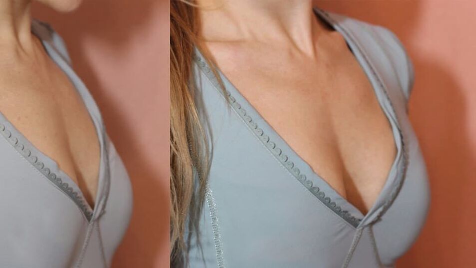 Products before and after breast enlargement