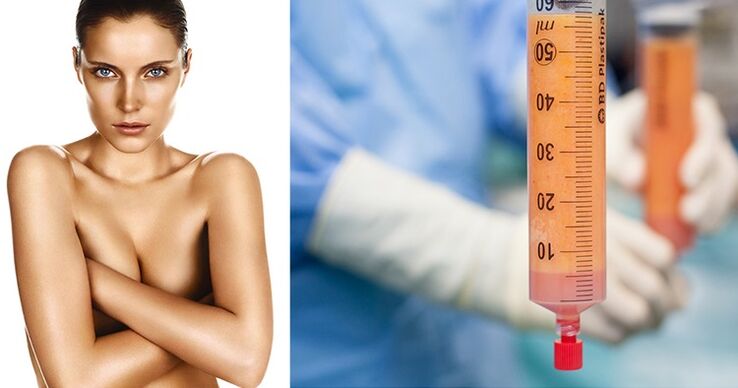 Lipofilling as a breast enlargement method