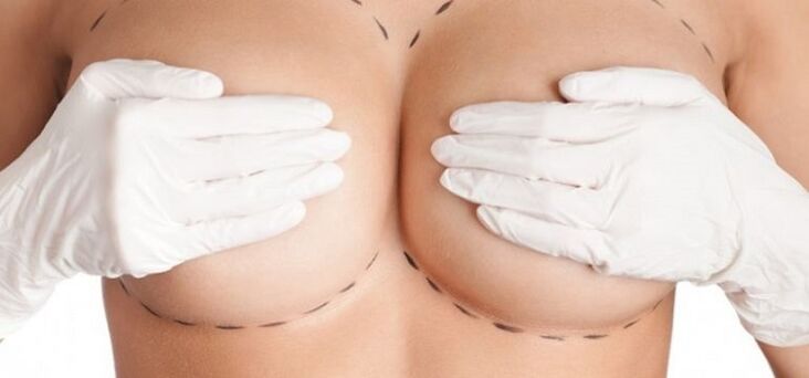 surgical breast enlargement