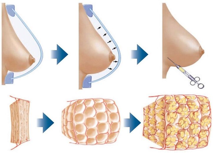 surgical method for breast enlargement