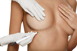 Mark with a marker in front of the breast augmentation